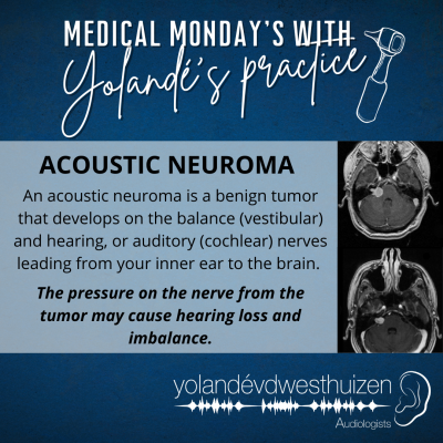 YvDW Audiologists - Medical Mondays - Acoustic Neuroma